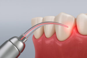 Illustration of dental implant placement in the jaw