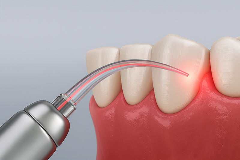 Dental Implants