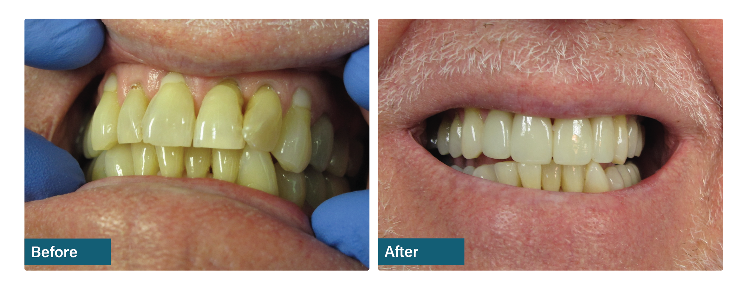 Brighter upper smile before and after dental result