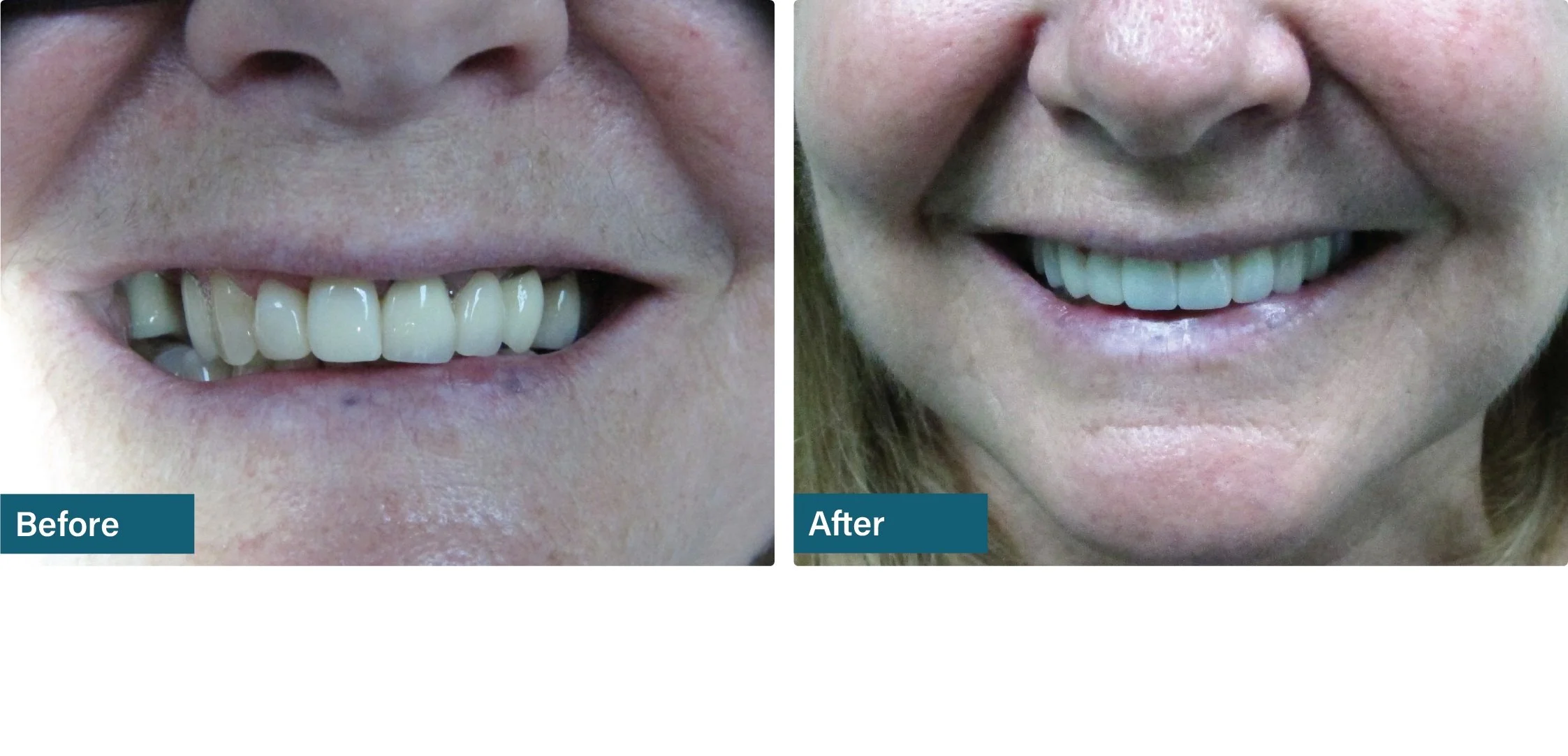 Porcelain crowns and bridges before and after dental result