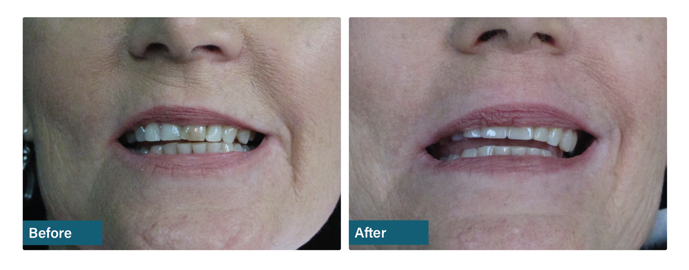 Porcelain veneer match before and after dental result