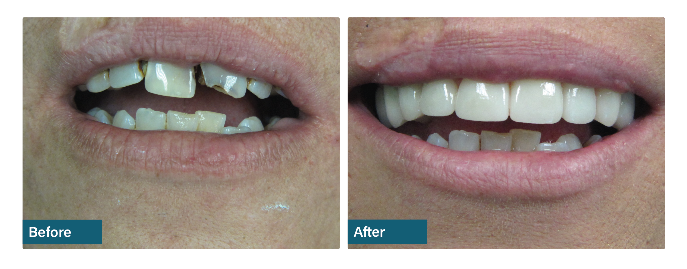 Complete upper restoration before and after dental result