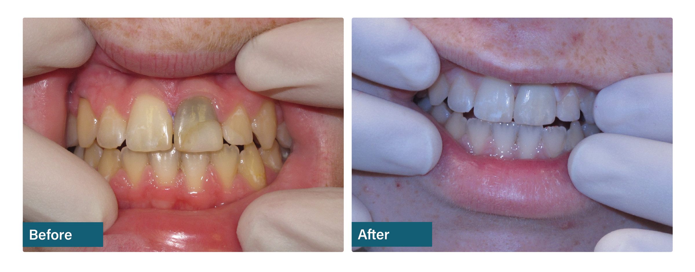 Custom shade match before and after dental result